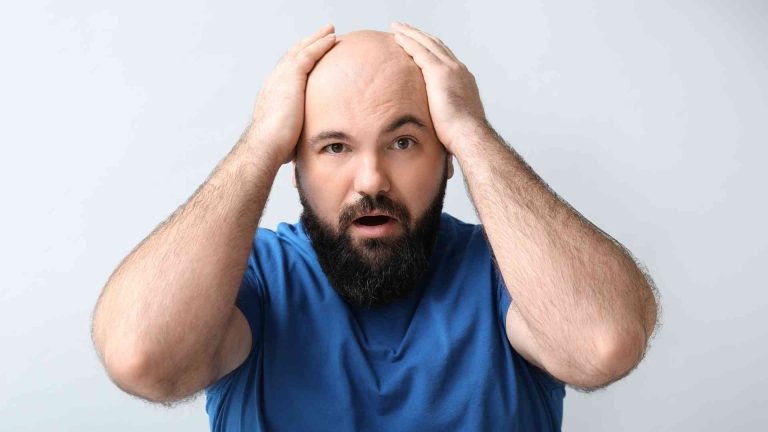 Can Genetic Hair Loss Be Stopped? Diagnosis and Treatment