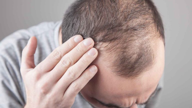 Does Creatine Cause Hair Loss? Debunking the Myths Guide