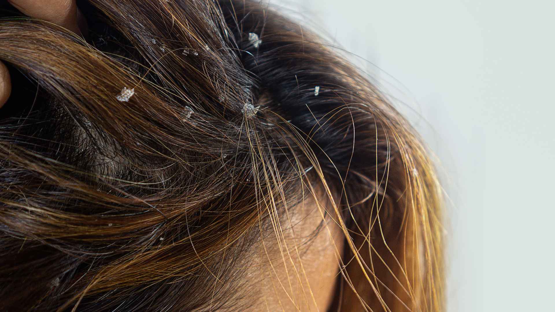 does dandruff cause hair loss