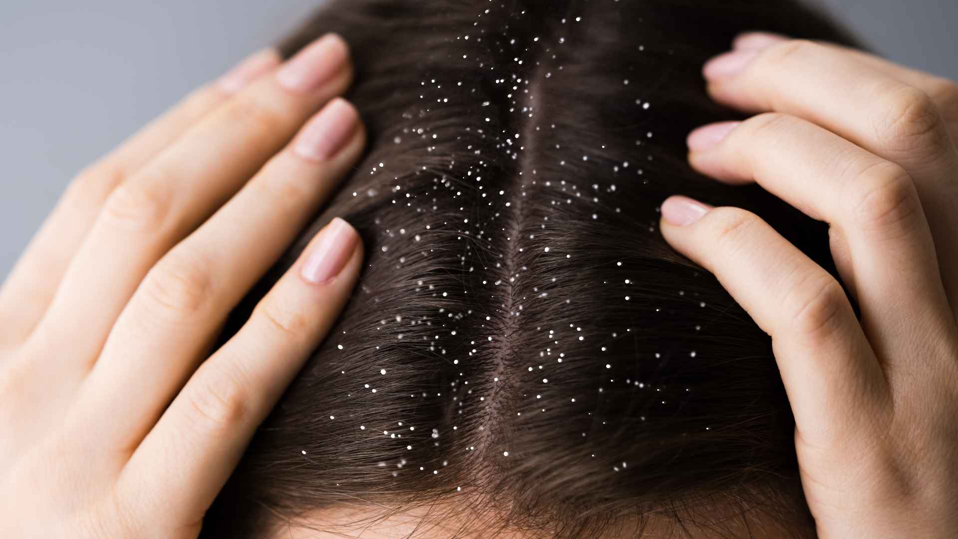 Can Dandruff Lead to Hair Loss? Debunking the Myth Guide