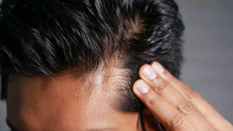 Can Drinking Alcohol Cause Hair Loss? Are They Connected?