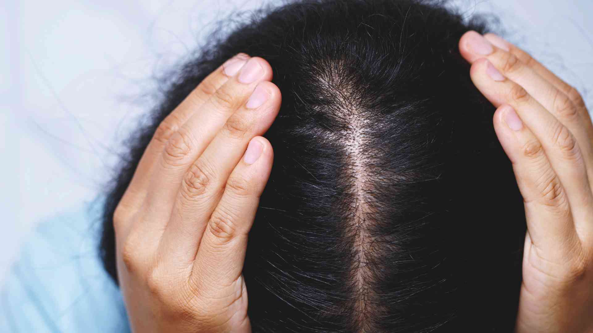 What role does scalp health play in preventing hair loss