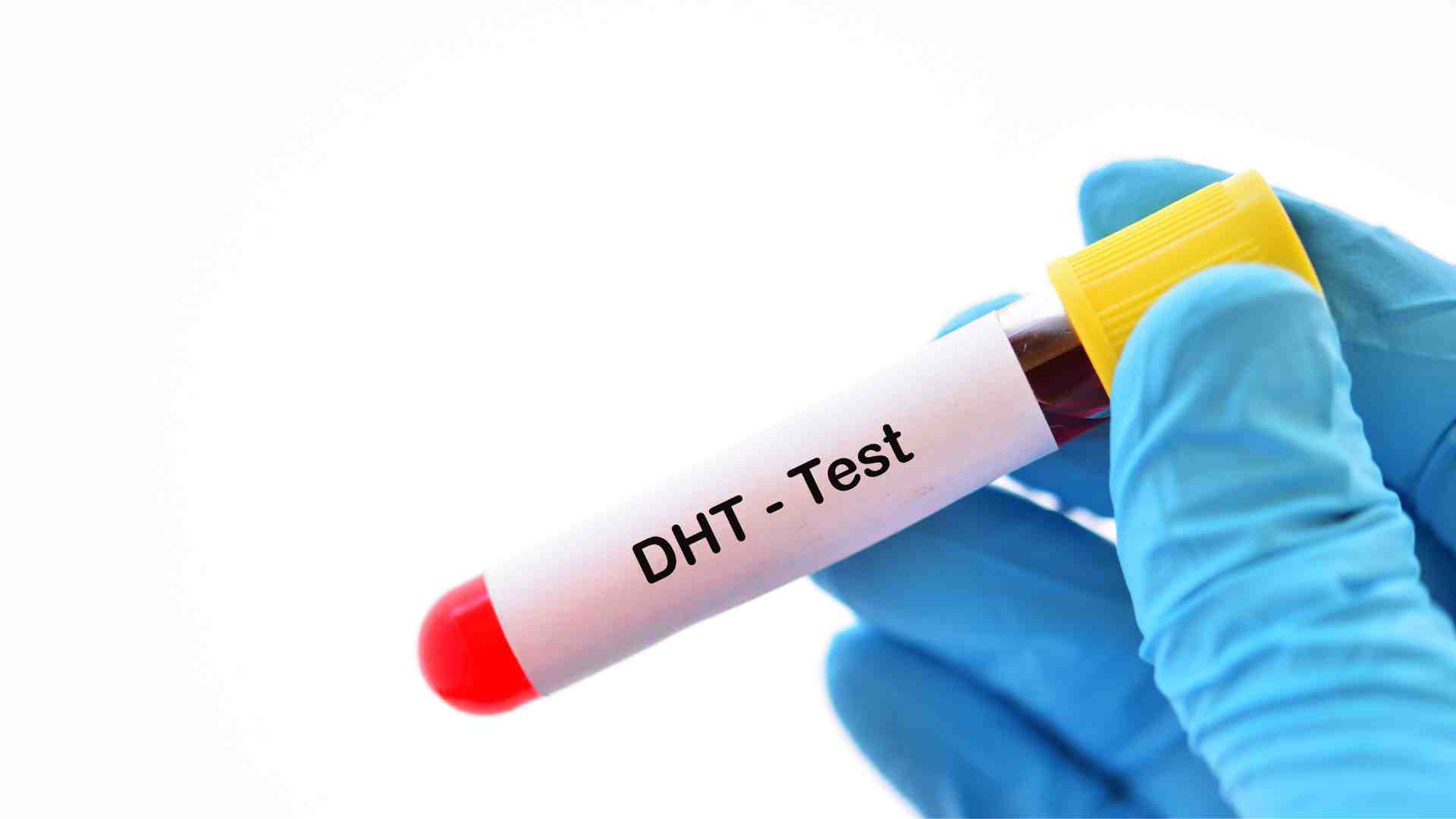 What Is the Role of DHT in Hair Loss?