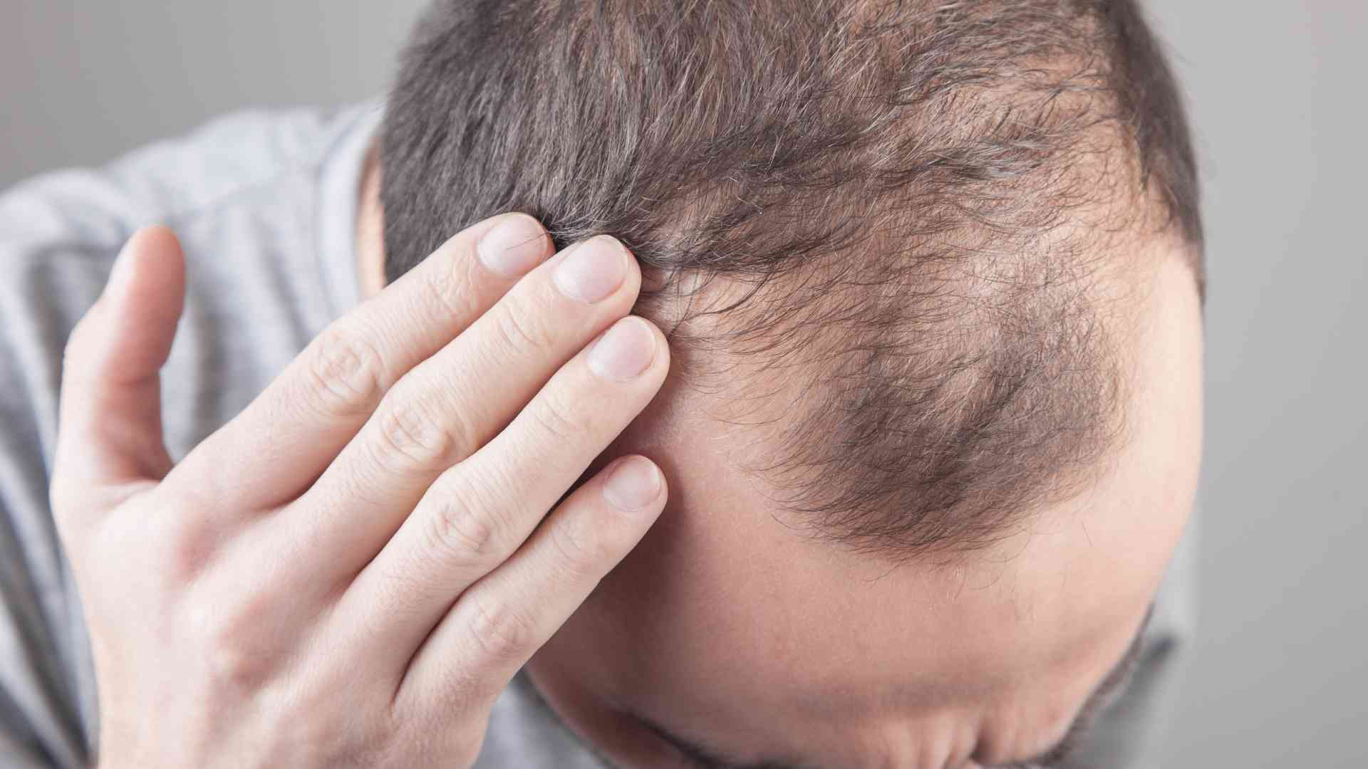 can drinking alcohol cause hair loss 1