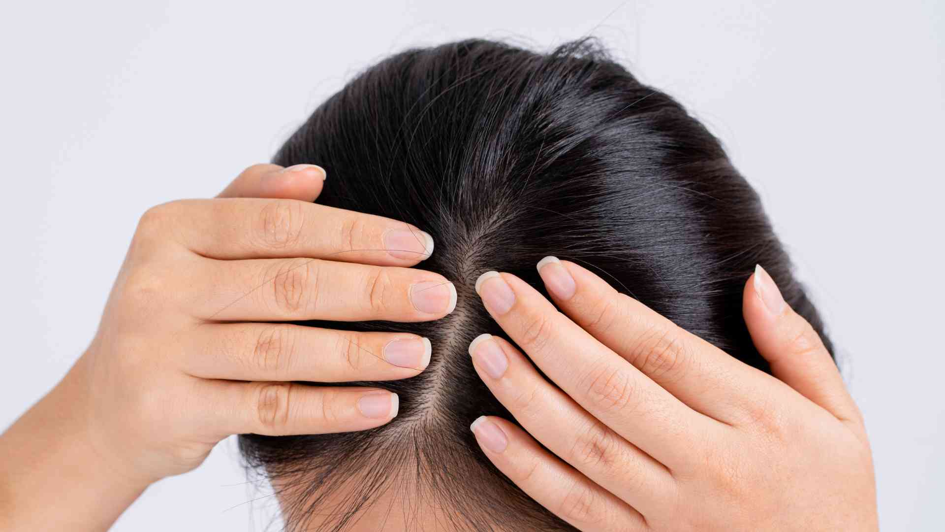 What role does scalp health play in preventing hair loss