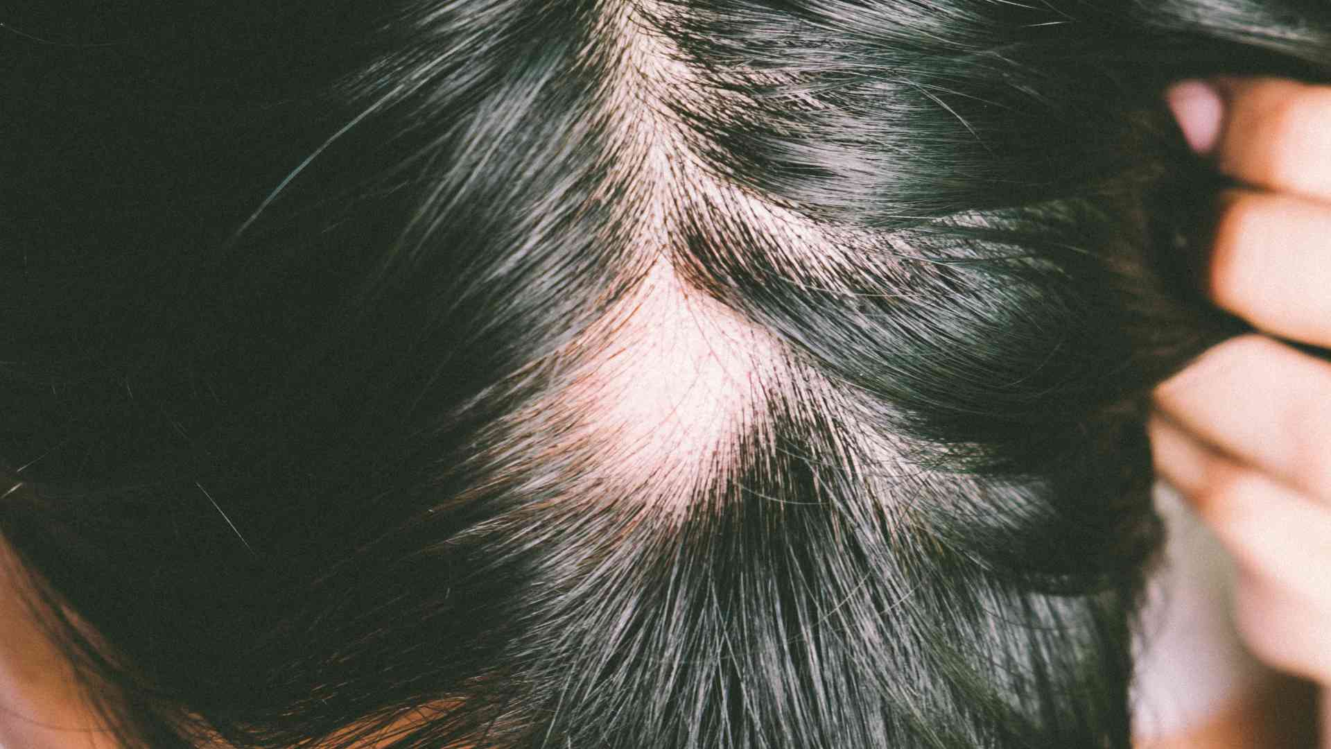 How do genetics play a role in male pattern baldness