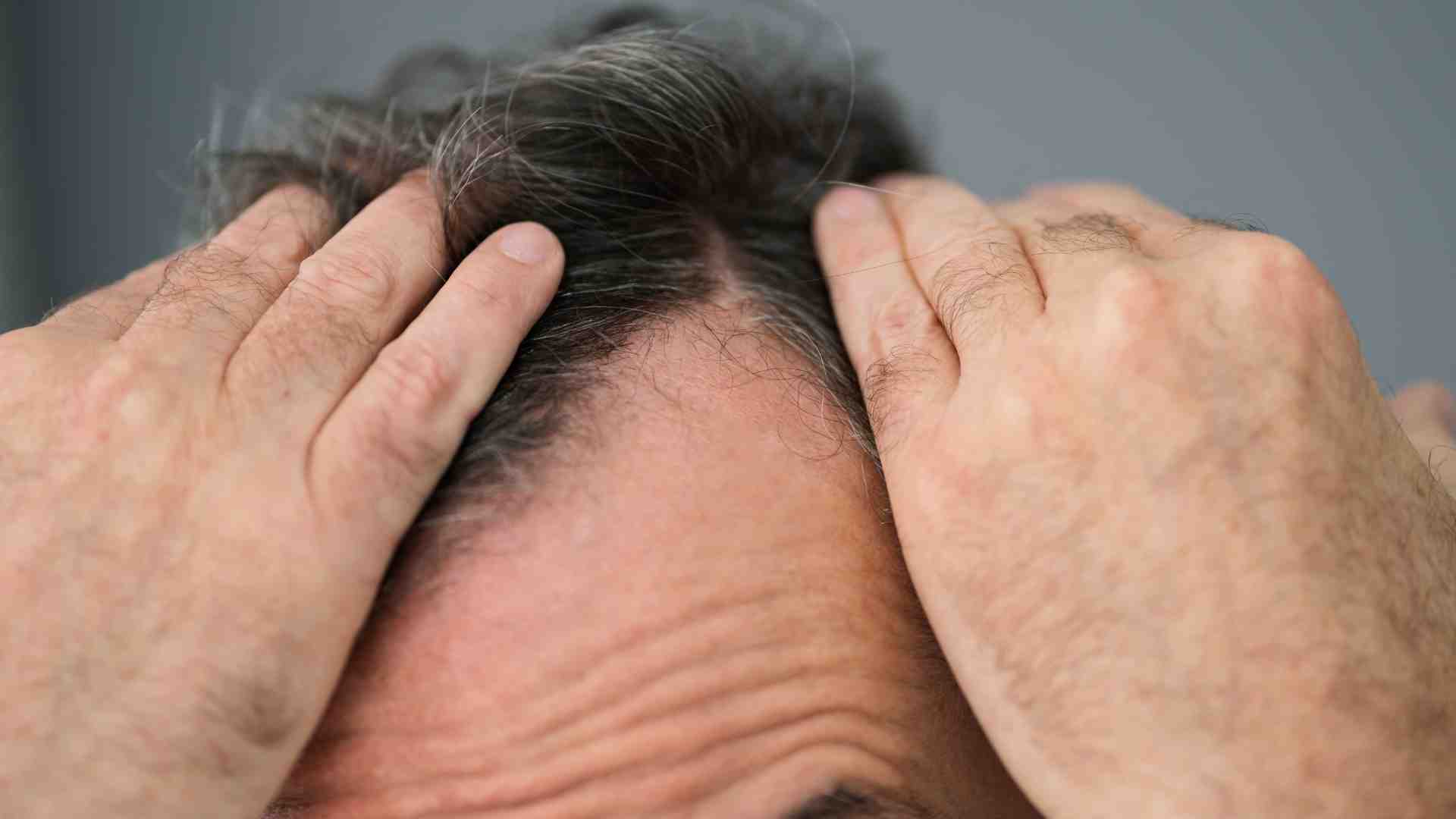 What is the role of DHT in hair loss