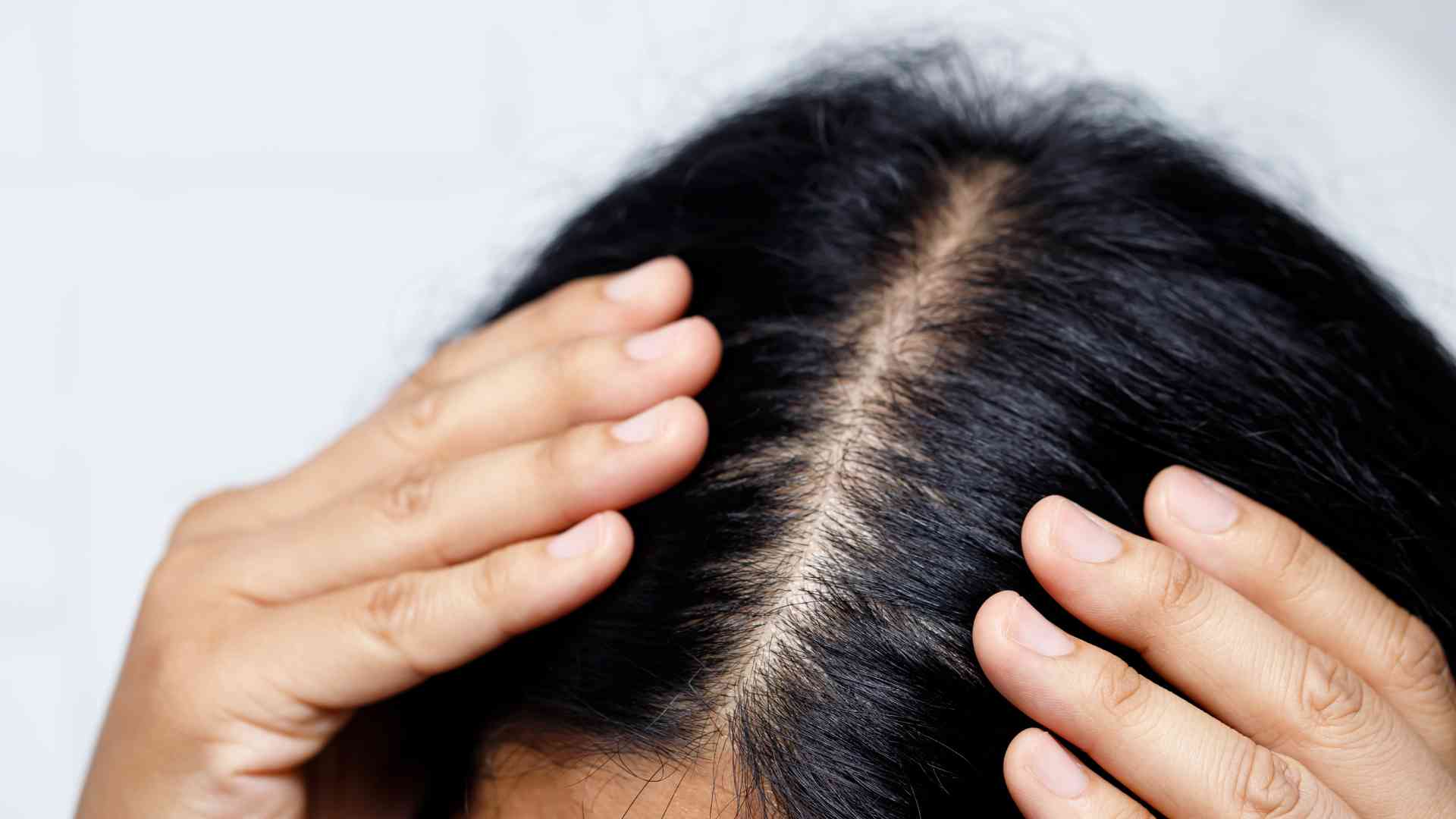 What is traction alopecia and what causes it