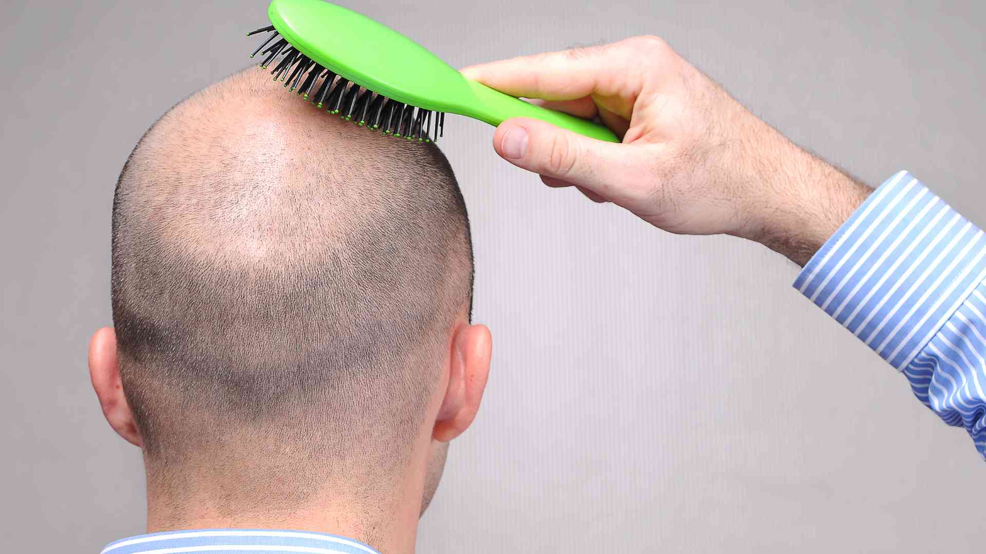 Can Eating Too Much Protein Cause Hair Loss Guide 360hairloss