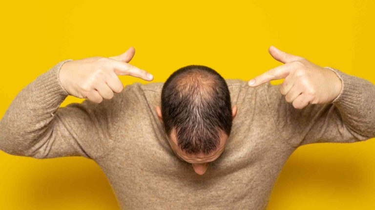 Can Age Cause Hair Loss? How to Stop It? Guide