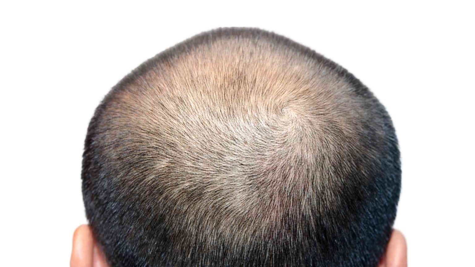 How Do Genetics Play A Role In Male Pattern Baldness?