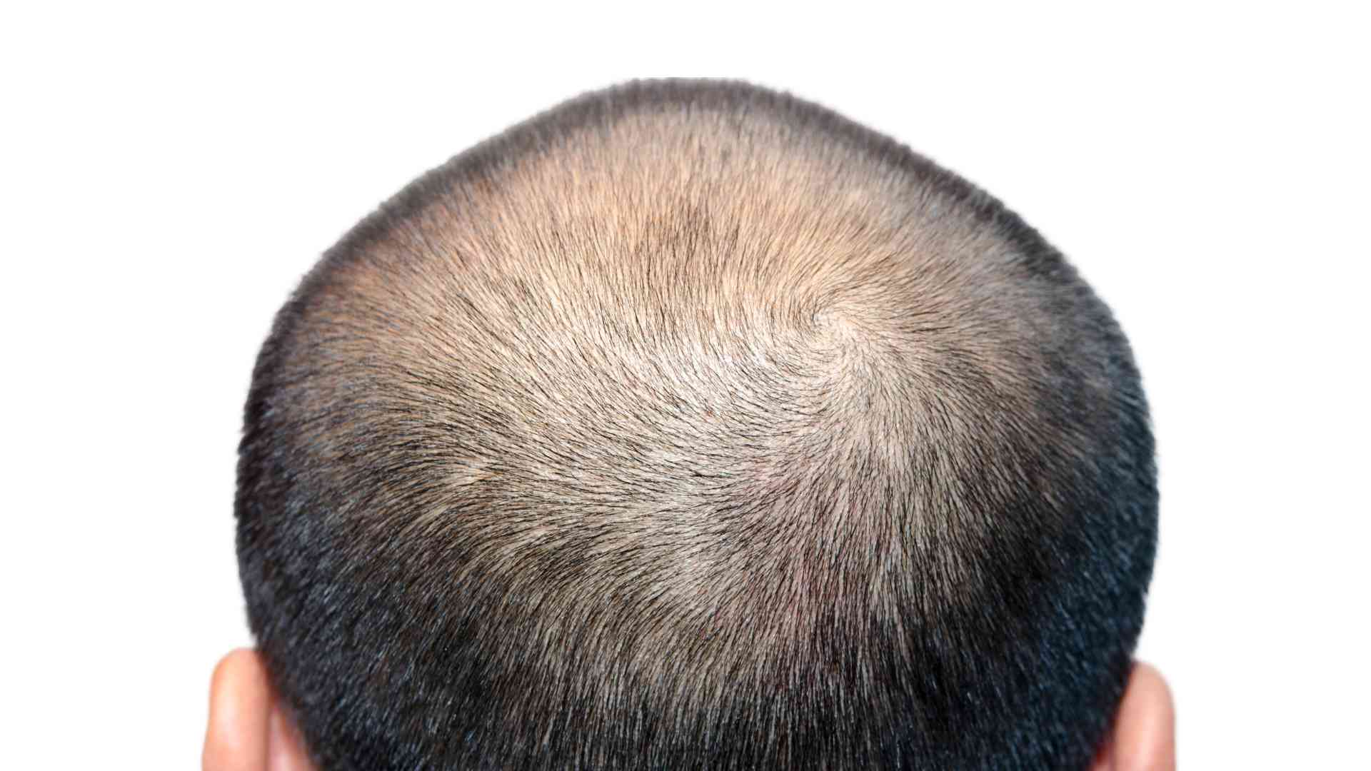 How do genetics play a role in male pattern baldness