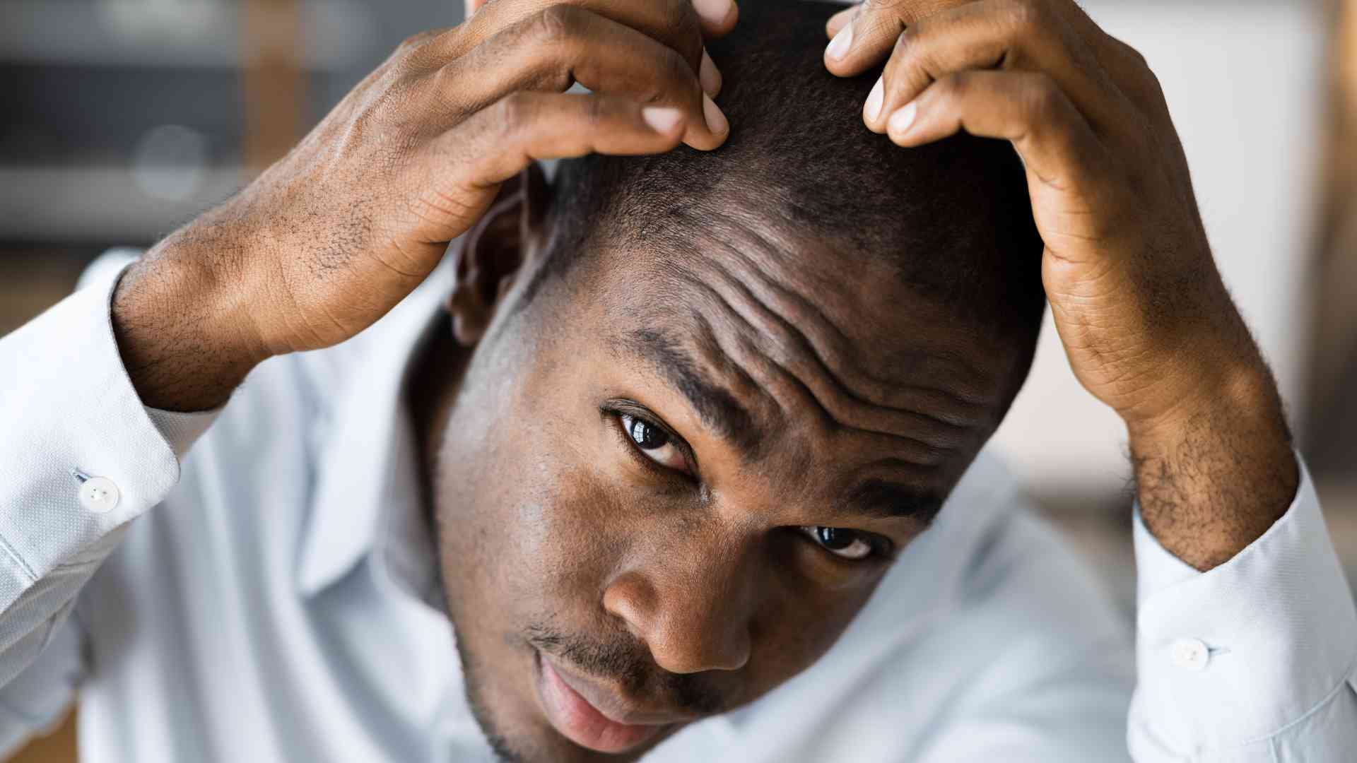 can drinking alcohol cause hair loss 1