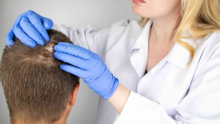 Can You Get Tested for Hair Loss? Guide to Diagnose