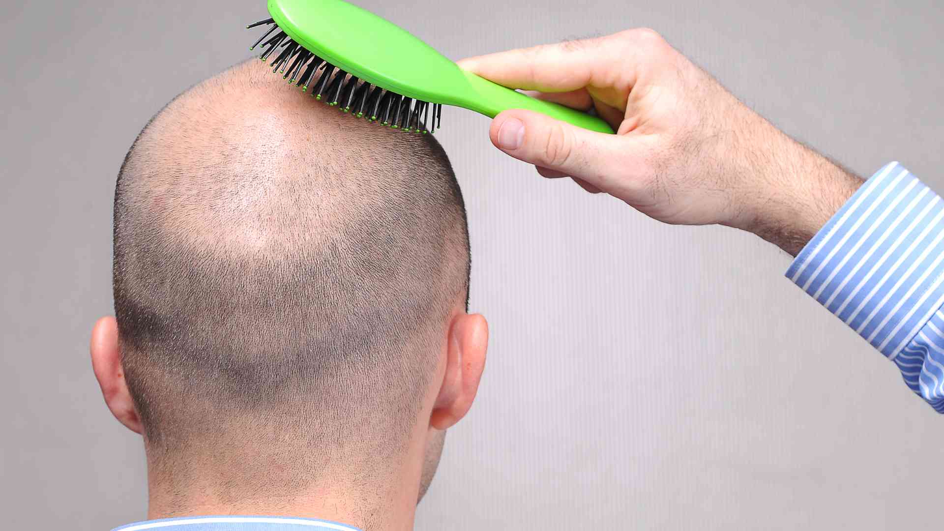 Are there any traditional or cultural practices that address hair loss 1