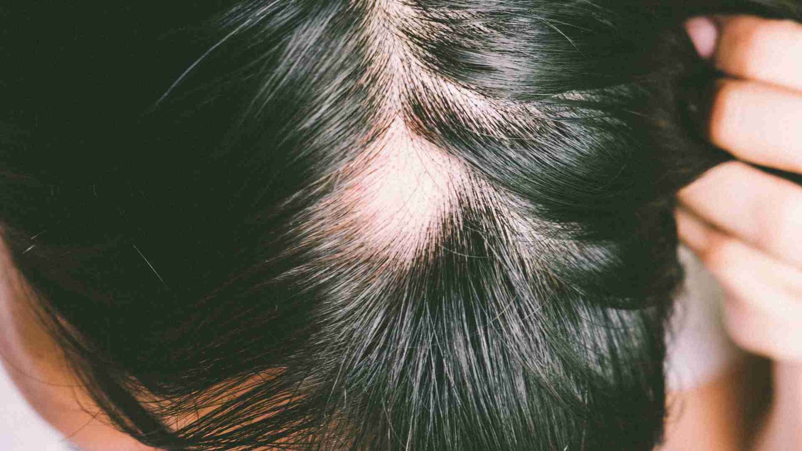ALOPECIA AREATA AWARENESS MONTH | September